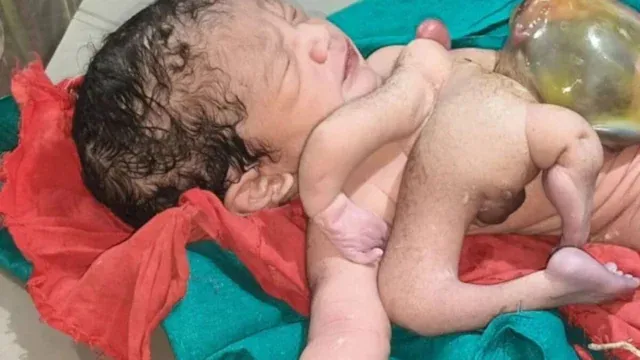 Chhatarpur News: लवकुशनगर में पैदा हुआ अनोखा बच्चा, डॉक्टरों ने बताया दुर्लभ मेडिकल केस; जानिए क्या है पूरा मामला